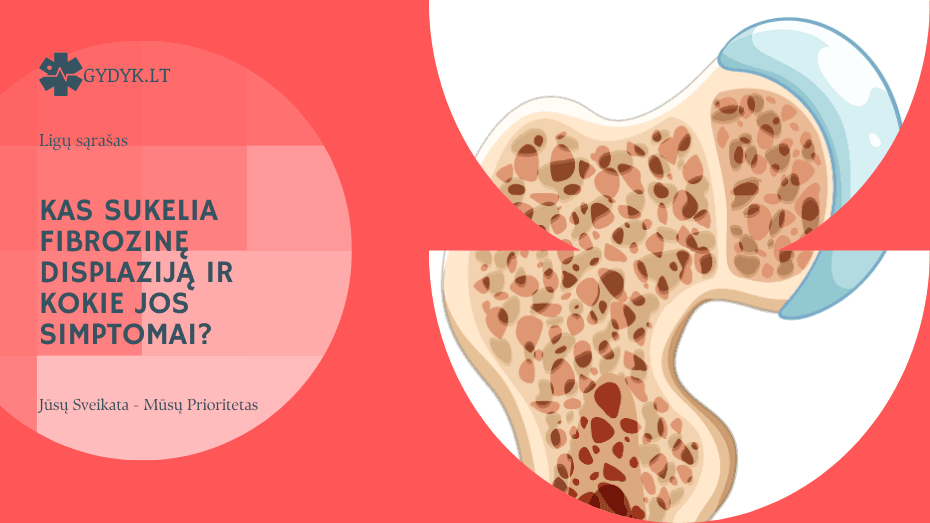 Kas sukelia fibrozinę displaziją ir kokie jos simptomai?