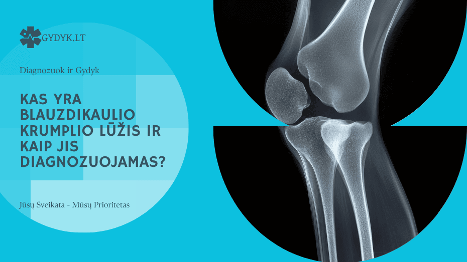 Kas yra blauzdikaulio krumplio lūžis ir kaip jis diagnozuojamas?
