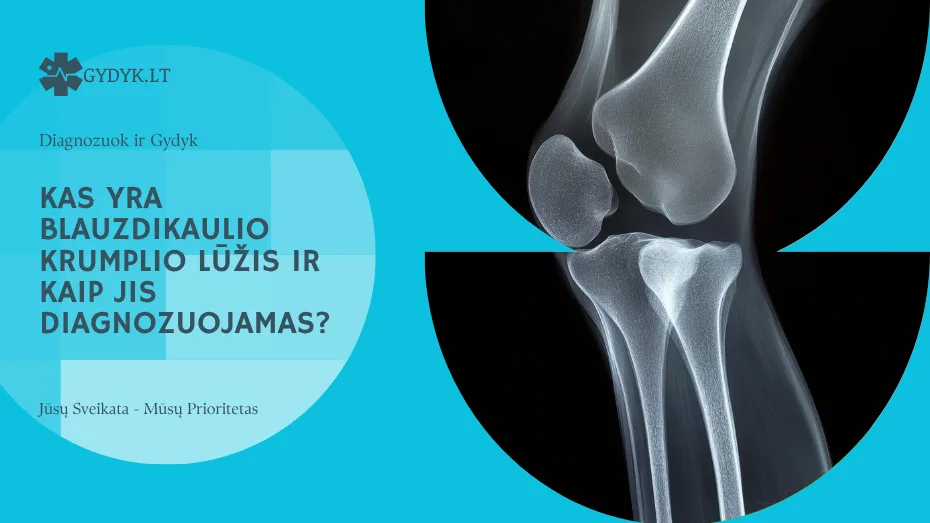 Kas yra blauzdikaulio krumplio lūžis ir kaip jis diagnozuojamas?