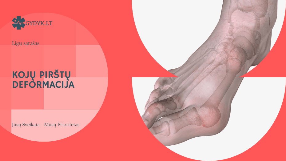 Kojų pirštų deformacija: kada padeda pratimai, o kada reikalinga operacija