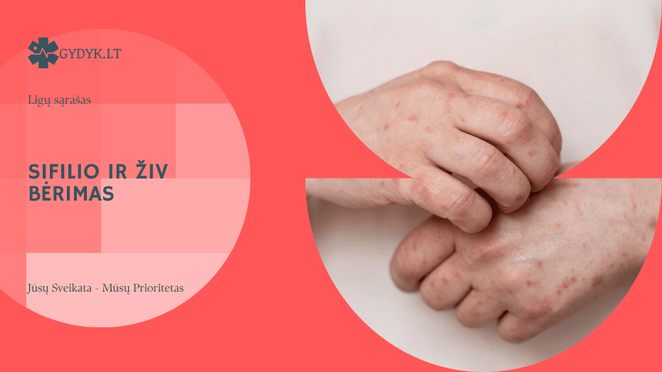 Sifilio ir ŽIV bėrimas: kaip atpažinti pavojingus simptomus