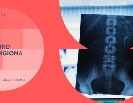 Stuburo hemangioma: simptomai, komplikacijos ir gydymo galimybės