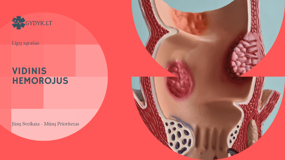 Vidinis hemorojus: simptomai, priežastys ir gydymo galimybės