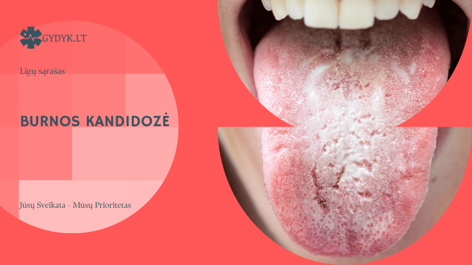 Burnos kandidozė: simptomai, gydymas ir tyrimai