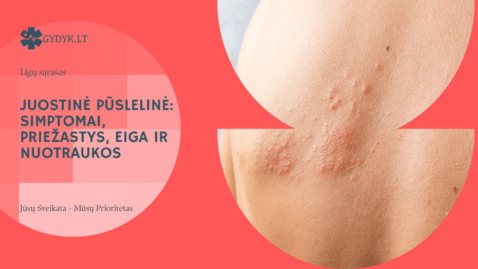 Juostinė pūslelinė: simptomai, priežastys, eiga ir nuotraukos
