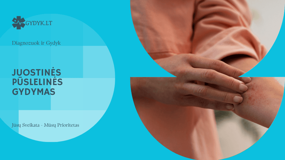 Juostinės pūslelinės gydymas: vaistai, tepalai ir ką galima daryti