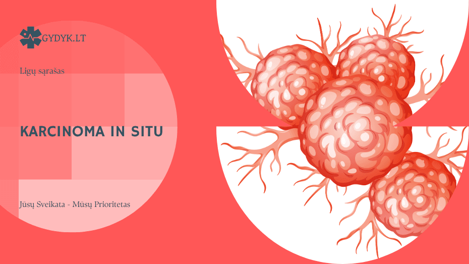 Karcinoma in situ: kas tai ir kuo skiriasi nuo invazinės