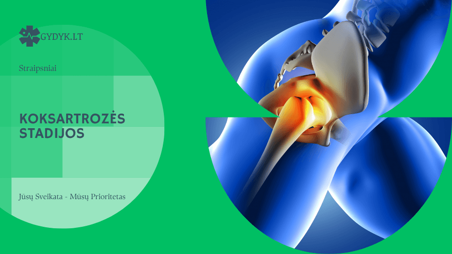 Koksartrozės stadijos: 1, 2 ir 3 stadijos skirtumai ir eiga