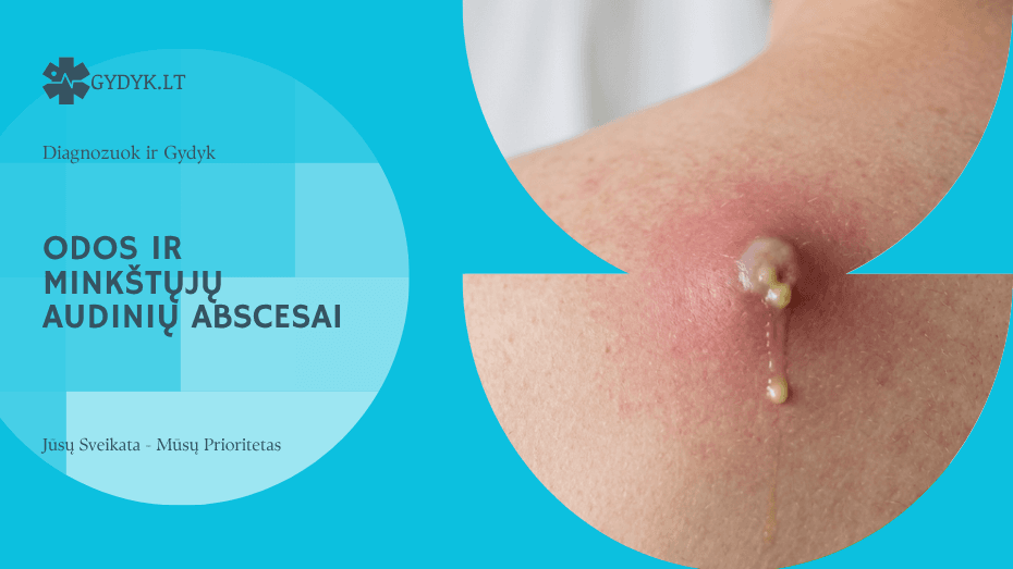 Odos ir minkštųjų audinių abscesai: priežastys ir gydymas