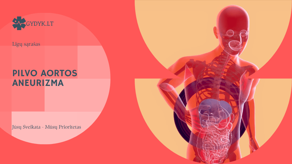 Pilvo aortos aneurizma: simptomai, rizika ir gydymas