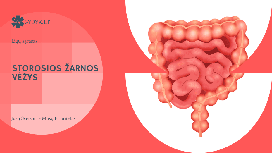 Storosios žarnos vėžys: išgyvenamumas ir kas jį lemia?