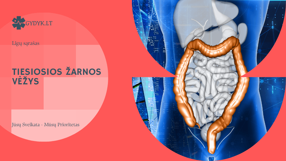 Tiesiosios žarnos vėžys: ankstyvi simptomai, rizikos veiksniai ir kada būtina kreiptis į gydytoją