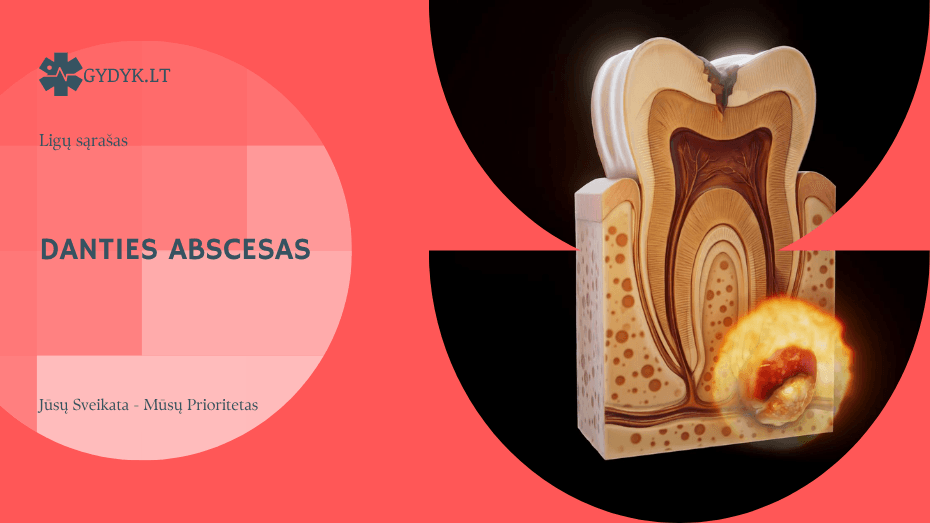 Danties abscesas: Kas tai, kaip atsiranda ir kaip gydomas?
