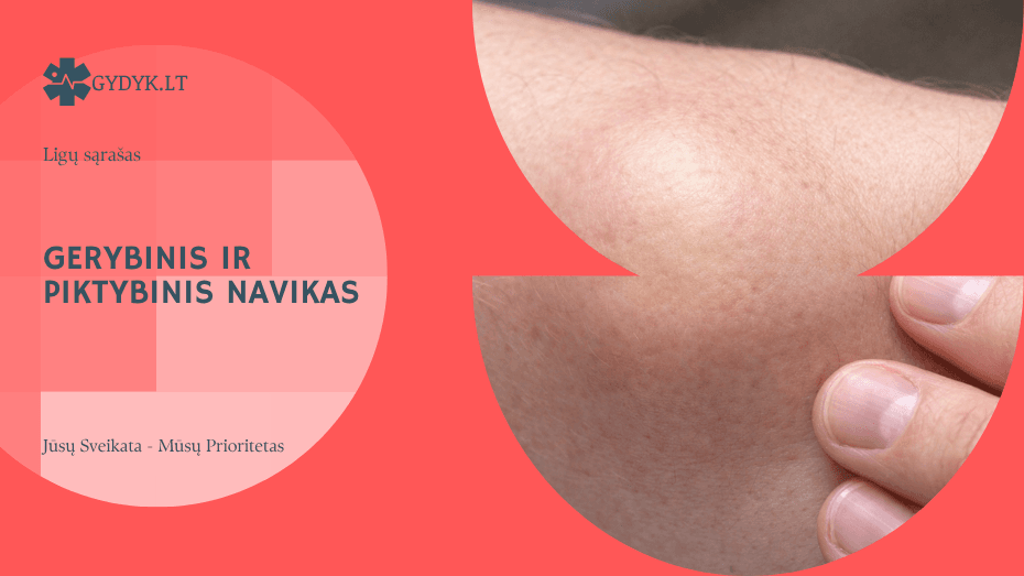 Gerybinis ir piktybinis navikas: skirtumai, tipai ir požymiai