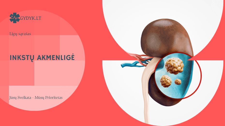 Inkstų akmenligė: simptomai, priežastys, gydymas ir dieta