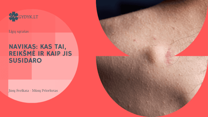 Navikas: kas tai, reikšmė ir kaip jis susidaro - Gydyk.lt