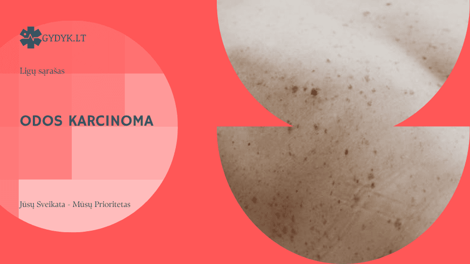 Odos karcinoma: bazinių ir plokščialąstelinių ląstelių vėžys
