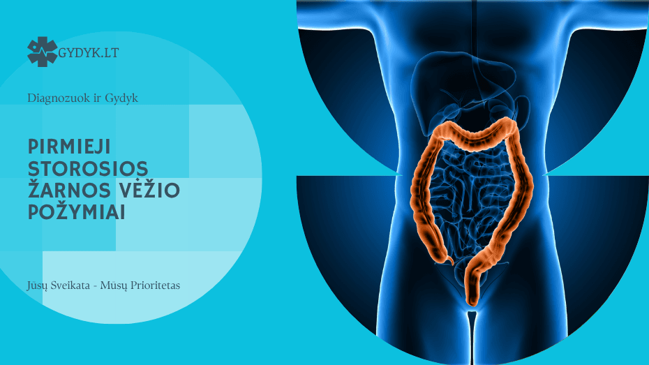 Pirmieji storosios žarnos vėžio požymiai: ką svarbu pastebėti kuo anksčiau