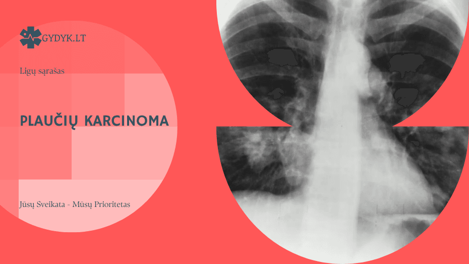 Plaučių karcinoma: tipai, simptomai ir plokščialąstelinė forma