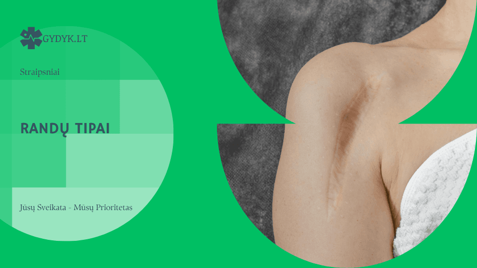 Randų tipai: keloidiniai, hipertrofiniai ir atrofiniai randai