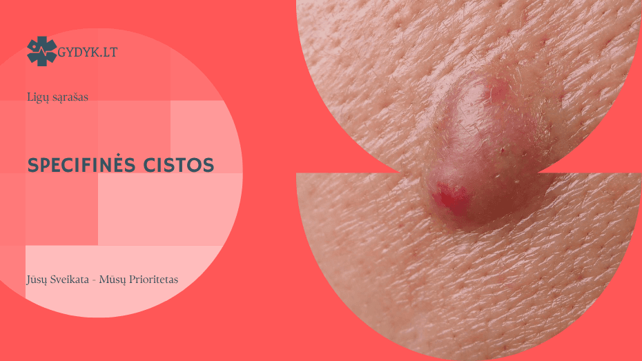 Specifinės cistos: dermoidinė, epiderminė, arachnoidinė ir kt.