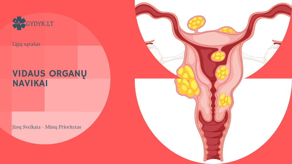 Vidaus organų navikai: kasos, gimdos, kiaušidžių ir kitų organų navikai
