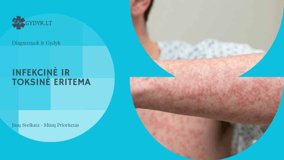 Infekcinė ir toksinė eritema: priežastys ir gydymas