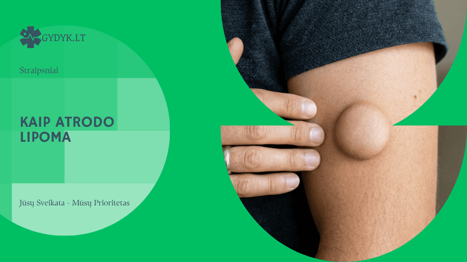 Kaip atrodo lipoma: nuotraukos ir skirtingos formos