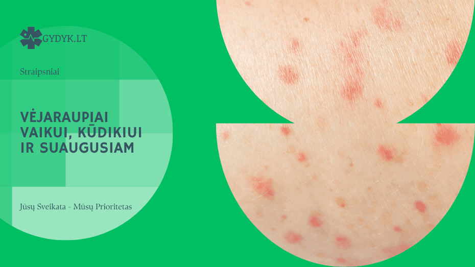 Vėjaraupiai vaikui, kūdikiui ir suaugusiam: kuo skiriasi ligos eiga ir priežiūra?