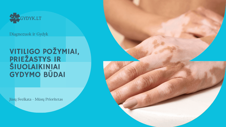 Vitiligo požymiai, priežastys ir šiuolaikiniai gydymo būdai