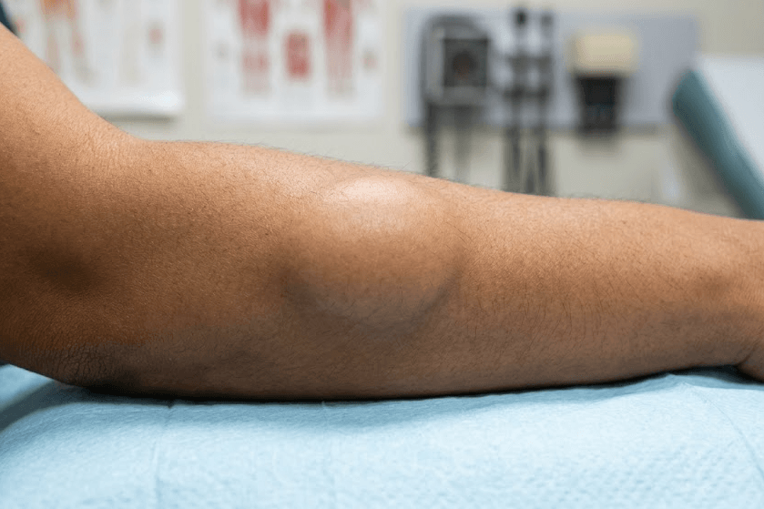 Kaip atrodo lipoma: nuotraukos ir skirtingos formos