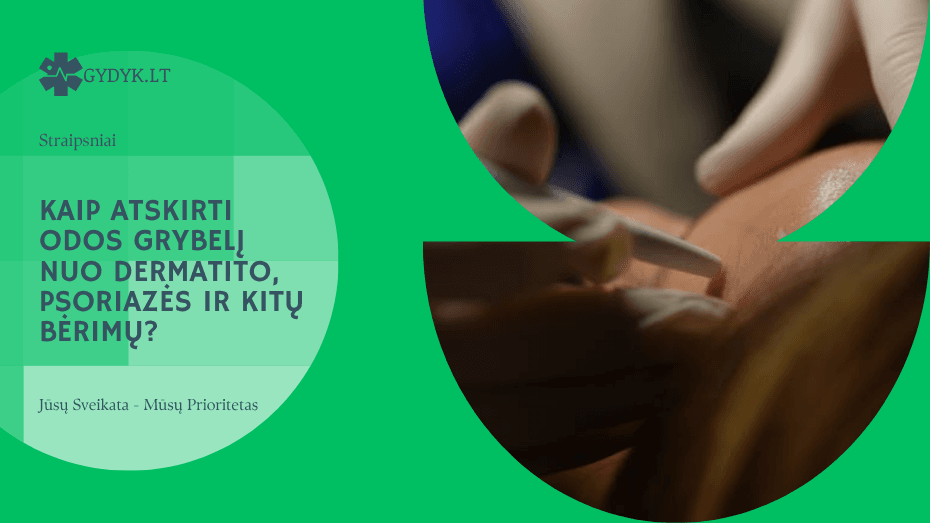 Kaip atskirti odos grybelį nuo dermatito, psoriazės ir kitų bėrimų?