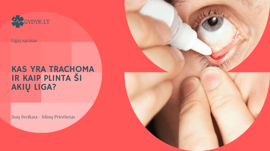 Kas yra trachoma ir kaip plinta ši akių liga?
