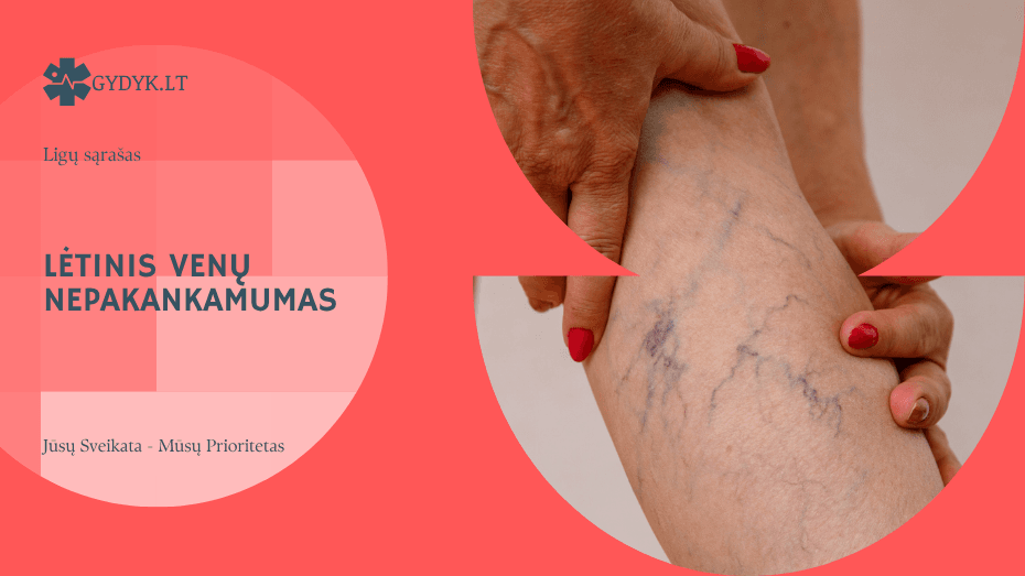 Lėtinis venų nepakankamumas – nuo simptomų iki efektyvaus gydymo