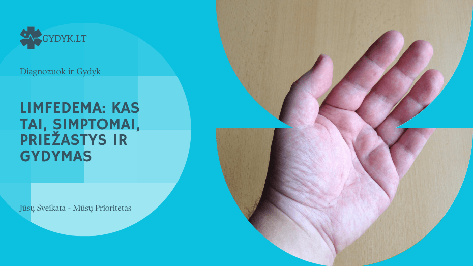 Limfedema: kas tai, simptomai, priežastys ir gydymas