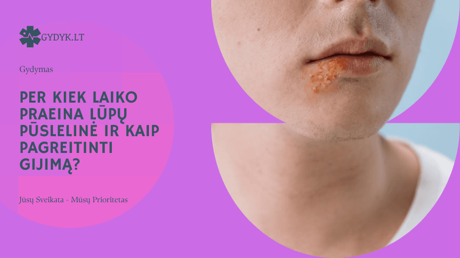 Per kiek laiko praeina lūpų pūslelinė ir kaip pagreitinti gijimą?