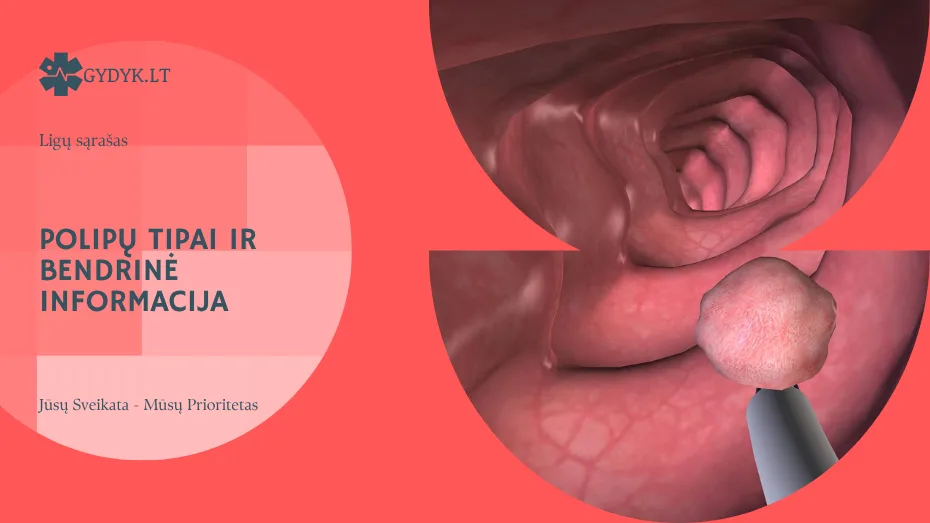 Polipų tipai ir bendrinė informacija: hiperplastiniai, endometriumo ir kt.