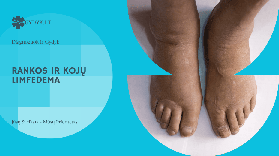Rankos ir kojų limfedema: simptomai, pratimai ir priežiūra
