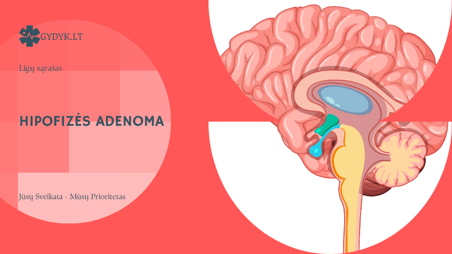 Hipofizės adenoma: simptomai, priežastys ir gydymo galimybės