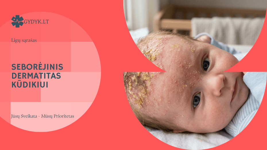 Seborėjinis dermatitas kūdikiui: kaip atpažinti, prižiūrėti odą ir kada kreiptis į gydytoją?