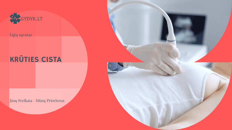 Krūties cista: simptomai, priežastys, diagnostika ir gydymas