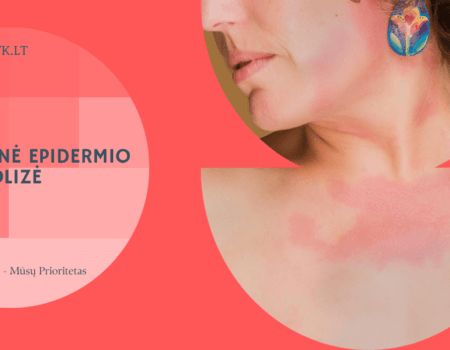 Toksinė epidermio nekrolizė – pavojinga odos reakcija, kurios negalima ignoruoti