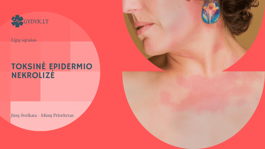 Toksinė epidermio nekrolizė – pavojinga odos reakcija, kurios negalima ignoruoti