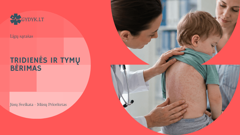 Tridienės ir tymų bėrimas – pagrindiniai skirtumai vaikams ir suaugusiems