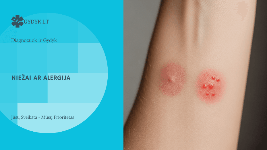 Iliustracija: Niežai ar alergija: kaip atskirti?
